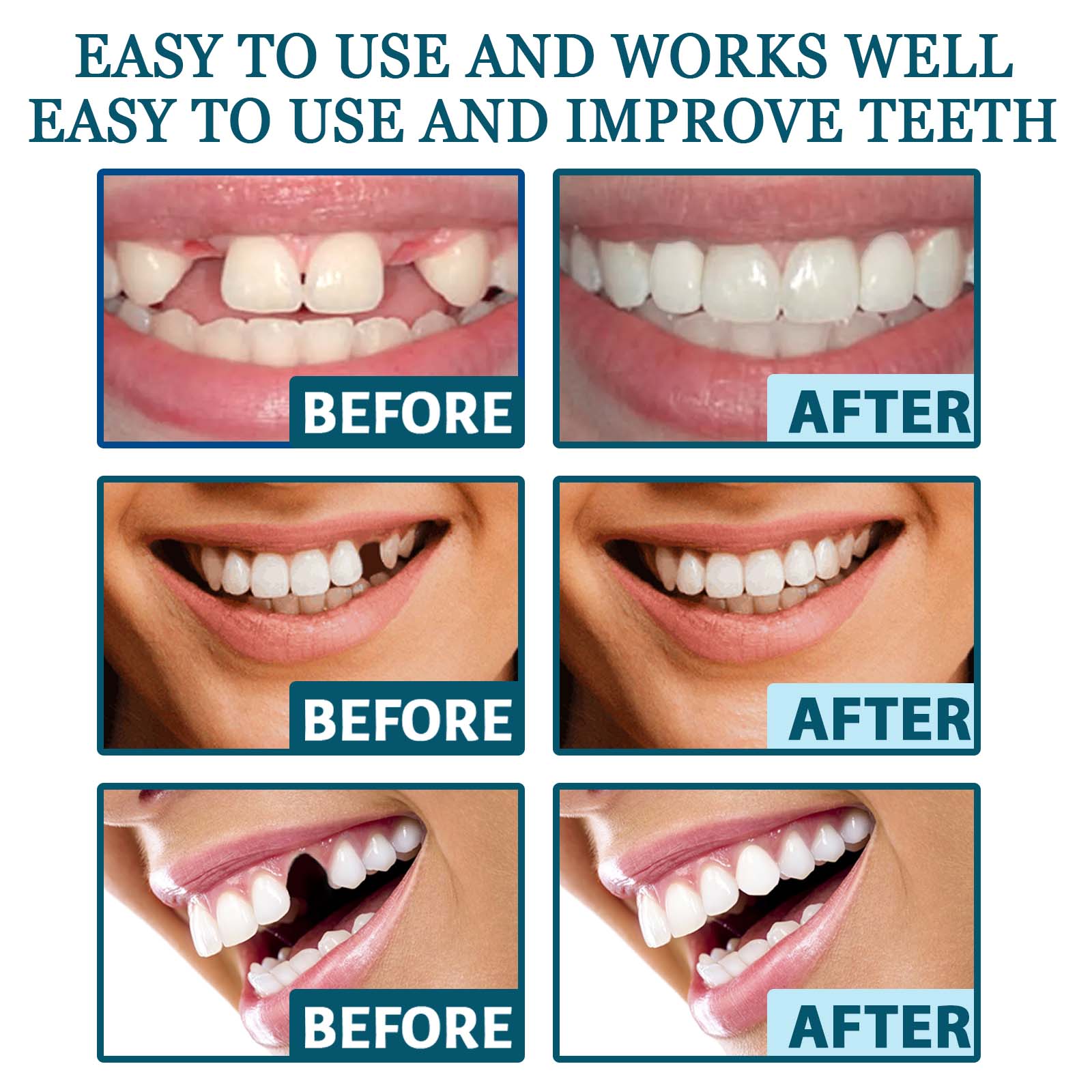 Adjustable Snap-On Dentures: Your Perfect Smile Solution - MANDOTOS